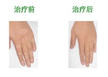 治疗费用