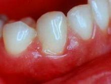 首页 症状 齿龈肿痛   所谓牙龈肿痛,实即牙齿根部痛,而且其周围齿肉