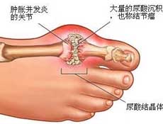 痛风