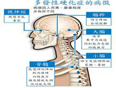 多发性硬化