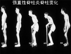 强制性脊椎炎