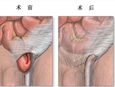 腹股沟疝