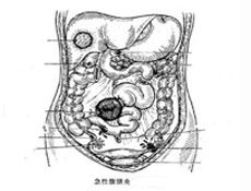 疾病分类