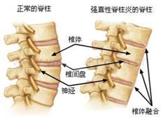 强直性脊柱炎与骨科关系