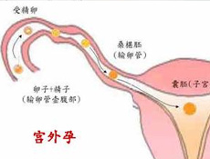 导致宫外孕的原因