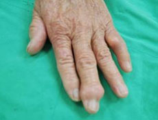 手部肿瘤的症状及治疗