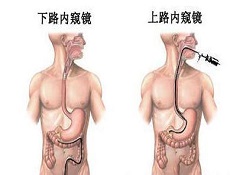 慢性浅表性胃炎