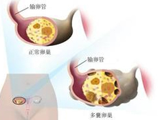 多囊卵巢综合征