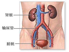 泌尿系结石