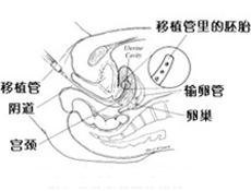 辅助生殖技术