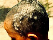 民间称秃疮,蒺藜头/瘌痢头,是由黄癣真菌感染头皮及头发致成,传染性很