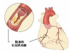 先天性心血管病的护理常识