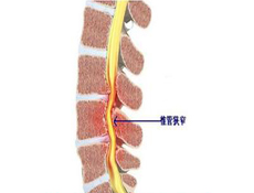 腰椎器官狭窄