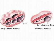 多囊卵巢综合症