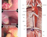 食管良性肿瘤是什么