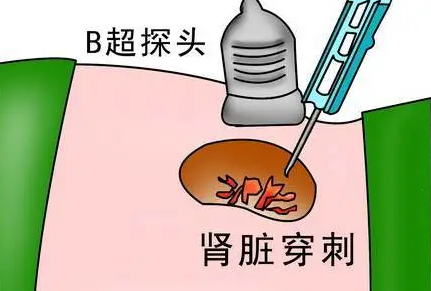 肾小球滤过率偏低严重怎么办？如何提高GFR？