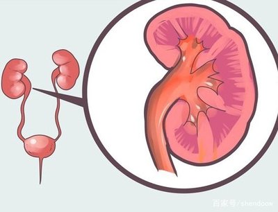 中医中药可以治肾病综合征吗？