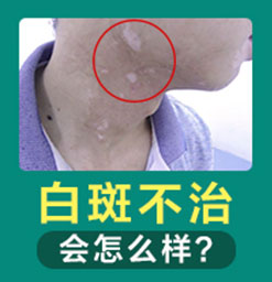 白斑患处的眉毛变白了怎么办