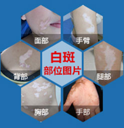 白癜风要怎么预防才能避免患上