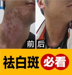 脚上的白癜风如何治疗恢复好