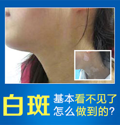 白斑遮盖液对患者的病情有哪些影响