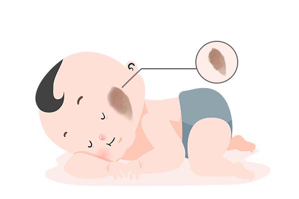 济南哪家胎记医院比较好