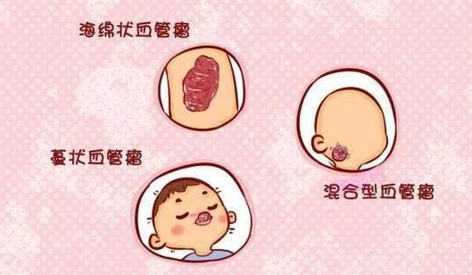 治疗血管瘤济南哪家医院好