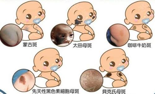 济南看胎记比较好的医院是哪家