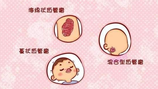 山东血管瘤医院排行？治疗婴幼儿血管瘤需要多长时间？