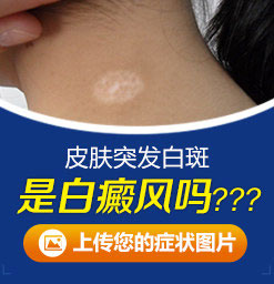 龙岩白癜风医院怎么样：白斑复发如何预防?