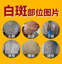 郑州白癜风哪个医院治白癜风比较好
