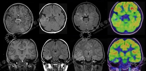 湖南看癫痫哪里医院比较好 湖南看早期癫痫那个医院好