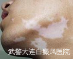 白癜風患者
