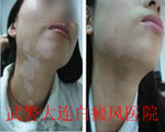 康復患者1