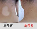 康復患者3