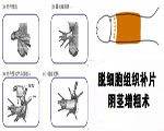 脫細(xì)胞組織補(bǔ)片陰莖增粗術(shù)