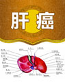 中醫(yī)治療肝癌