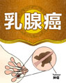 中醫(yī)治療乳腺癌