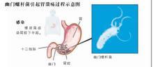 幽門螺桿菌