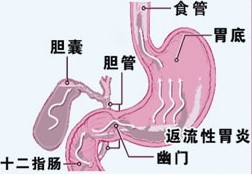 反流性食管炎